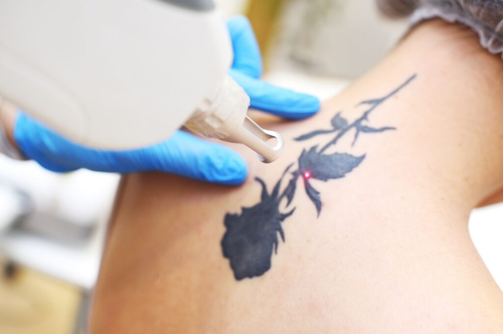 Tattoos | Queens Dermatologist | Queens Dermatology – Jordan Zuckerman MD