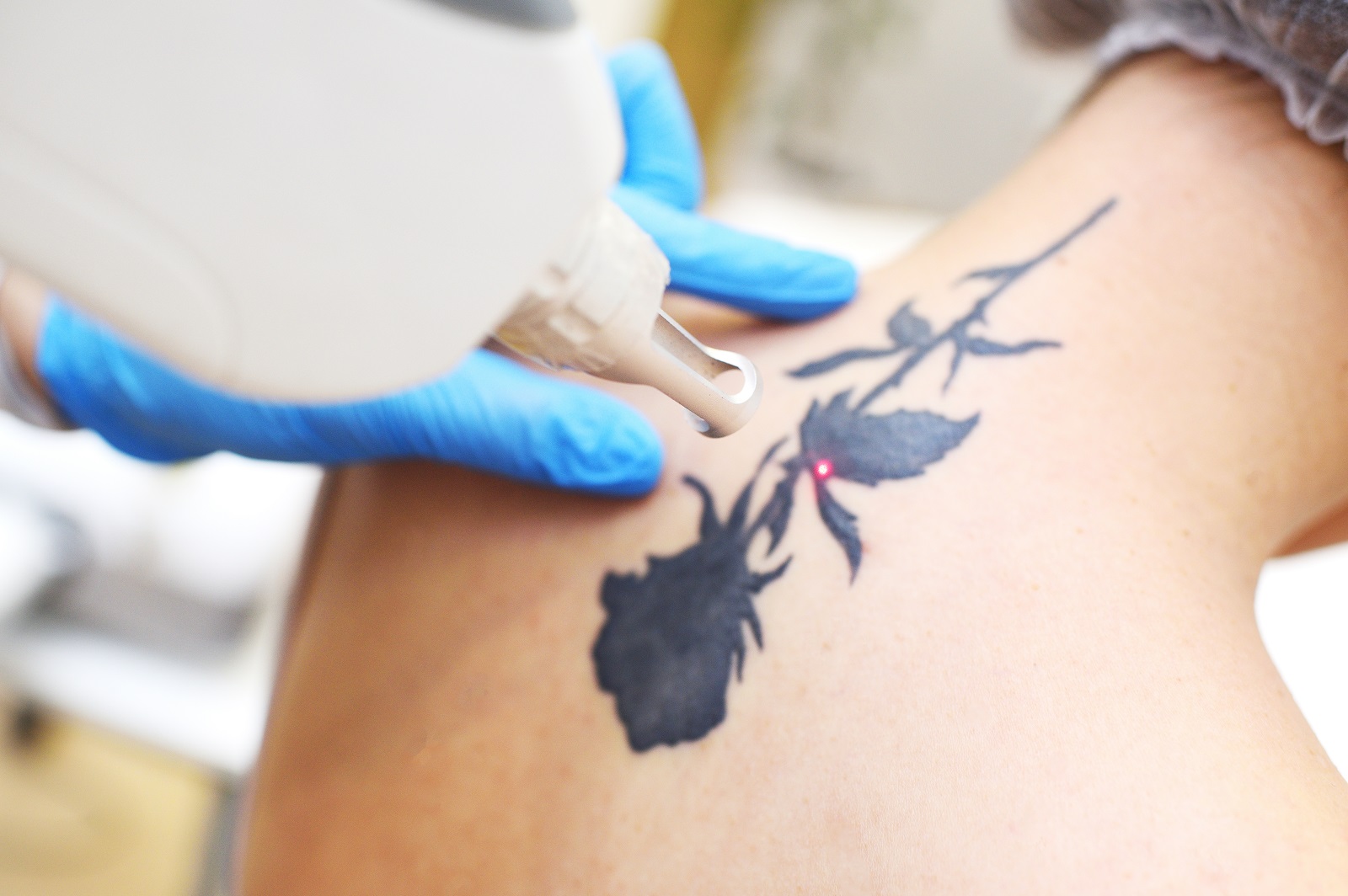 Trusted Laser Tattoo Removal in Detroit, MI | Dr. Beauty